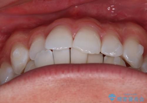 【インビザラインモニター】費用を抑えて歯並び改善!の治療中