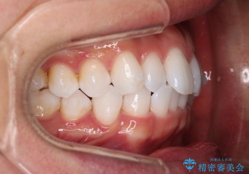 【インビザラインモニター】費用を抑えて歯並び改善!の治療中