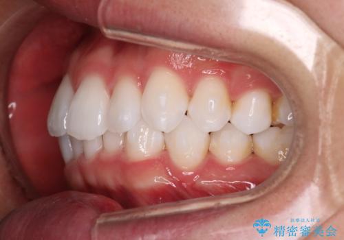 【インビザラインモニター】費用を抑えて歯並び改善!の治療中