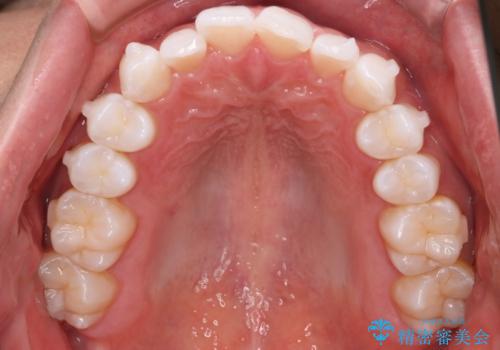【インビザラインモニター】費用を抑えて歯並び改善!の治療中
