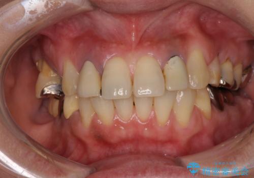 放置した破折歯 即時・早期のインプラント埋入による補綴治療の治療前