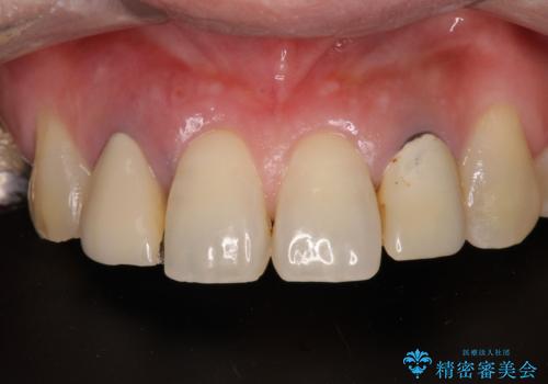 放置した破折歯 即時・早期のインプラント埋入による補綴治療の治療前
