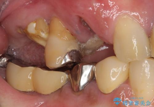 放置した破折歯 即時・早期のインプラント埋入による補綴治療の治療前