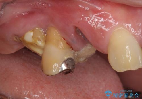 放置した破折歯 即時・早期のインプラント埋入による補綴治療の治療前