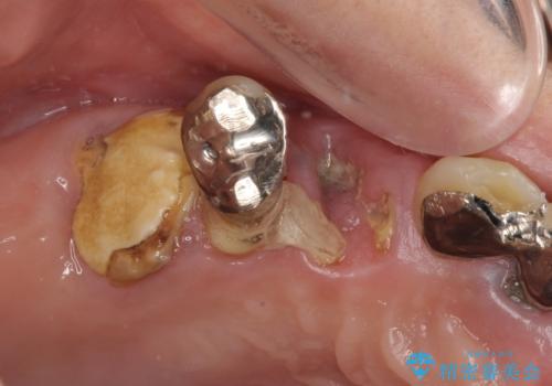 放置した破折歯 即時・早期のインプラント埋入による補綴治療の治療前