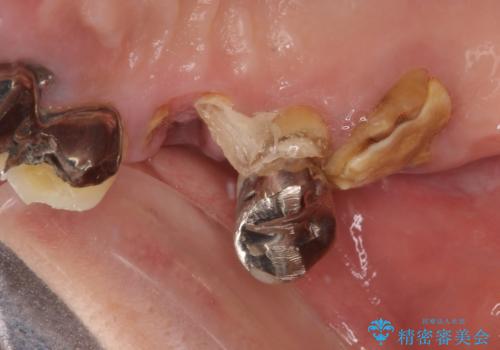 放置した破折歯 即時・早期のインプラント埋入による補綴治療の治療前