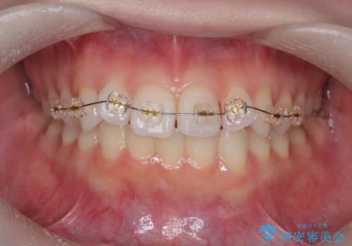前歯のねじれをきれいに 部分ワイヤー+マウスピース矯正