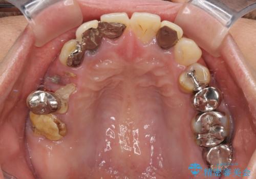 放置した破折歯 即時・早期のインプラント埋入による補綴治療の症例 治療前