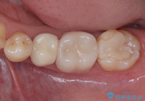 気になる奥歯のむし歯治療の治療前