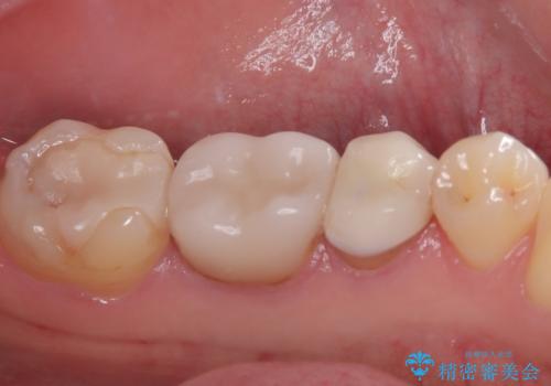 気になる奥歯のむし歯治療の治療前