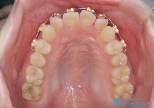 前歯のねじれをきれいに 部分ワイヤー+マウスピース矯正の治療前