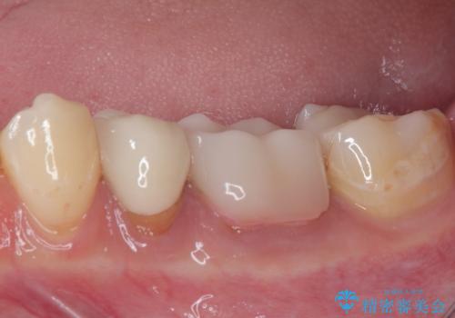 気になる奥歯のむし歯治療の治療前