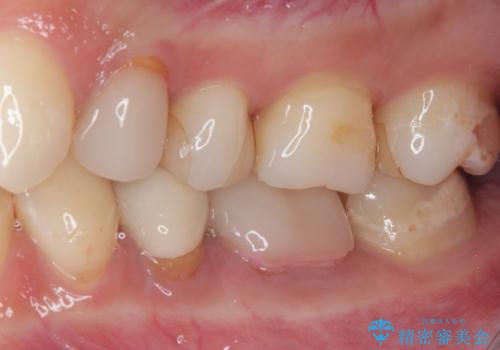 気になる奥歯のむし歯治療の治療前