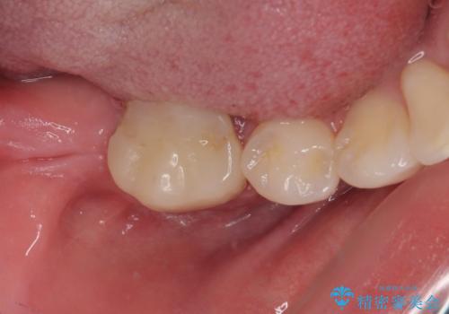 膨らんだ口元を改善する抜歯矯正 インプラント治療も同時に行う総合歯科治療の治療中