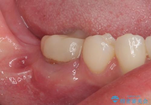 膨らんだ口元を改善する抜歯矯正 インプラント治療も同時に行う総合歯科治療の治療中