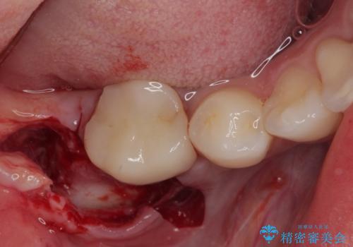 膨らんだ口元を改善する抜歯矯正 インプラント治療も同時に行う総合歯科治療の治療中