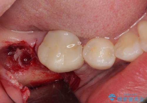 膨らんだ口元を改善する抜歯矯正 インプラント治療も同時に行う総合歯科治療の治療後