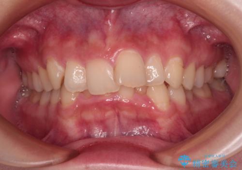 【モニター】デコボコと隠れてしまう前歯 ワイヤー装置による抜歯矯正で美しい口元にの症例 治療前