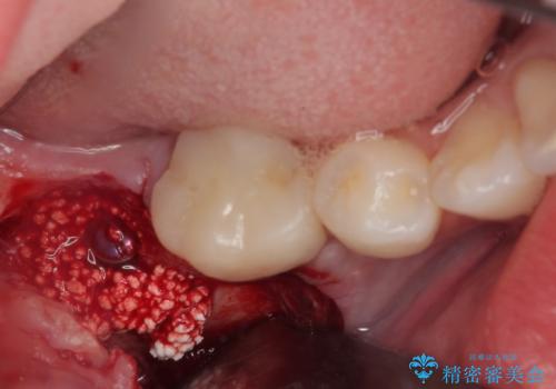 膨らんだ口元を改善する抜歯矯正 インプラント治療も同時に行う総合歯科治療の治療前