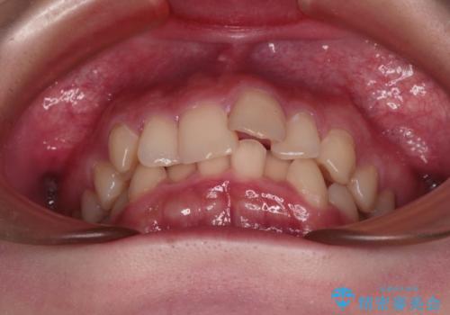 【モニター】デコボコと隠れてしまう前歯 ワイヤー装置による抜歯矯正で美しい口元にの治療前