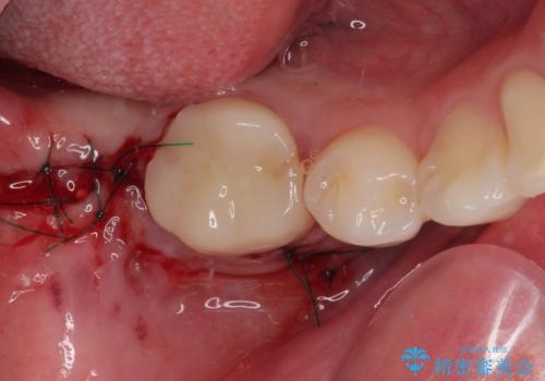 膨らんだ口元を改善する抜歯矯正 インプラント治療も同時に行う総合歯科治療の治療中