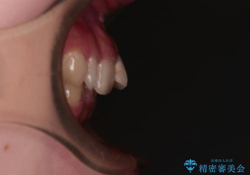 【モニター】デコボコと隠れてしまう前歯 ワイヤー装置による抜歯矯正で美しい口元にの治療前