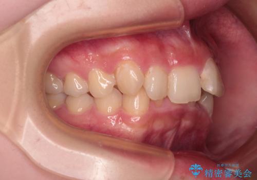 【モニター】デコボコと隠れてしまう前歯 ワイヤー装置による抜歯矯正で美しい口元にの治療前