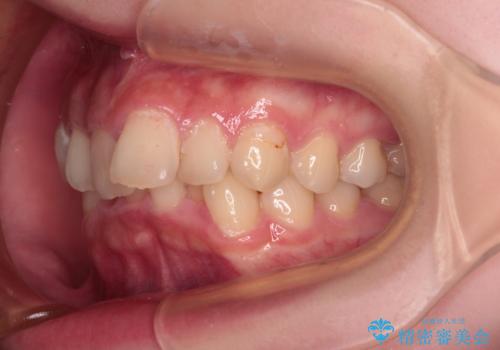 【モニター】デコボコと隠れてしまう前歯 ワイヤー装置による抜歯矯正で美しい口元にの治療前