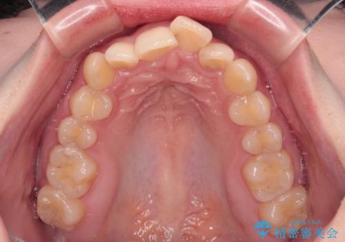 【モニター】デコボコと隠れてしまう前歯 ワイヤー装置による抜歯矯正で美しい口元にの治療前