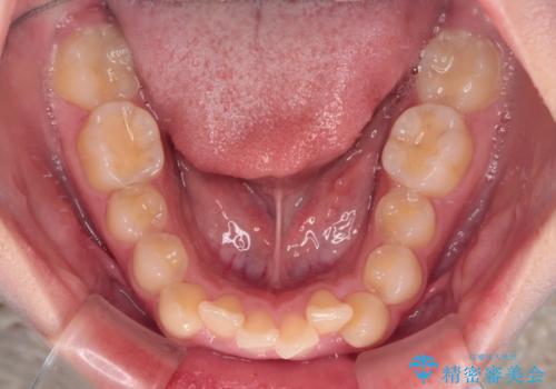 【モニター】デコボコと隠れてしまう前歯 ワイヤー装置による抜歯矯正で美しい口元にの治療前