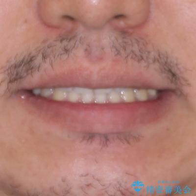 隙間だらけの歯列を治したい ワイヤー矯正での矯正治療の治療後(顔貌)