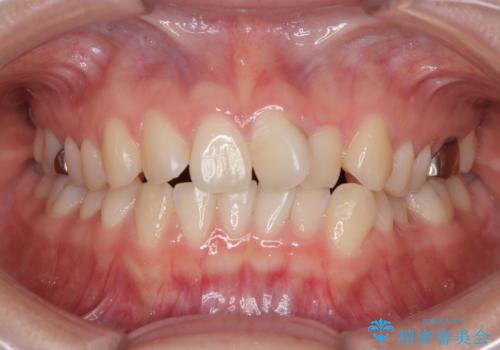 前歯のねじれ・ガタガタを10か月で改善!20代女性の矯正治療|クリアブラケットでむし歯になりにくい歯並びへ改善