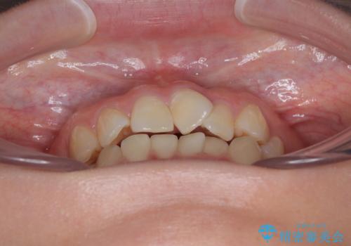 前歯のねじれ・ガタガタを10か月で改善!20代女性の矯正治療|クリアブラケットでむし歯になりにくい歯並びへ改善の治療前