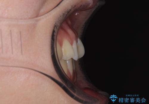 前歯のねじれ・ガタガタを10か月で改善!20代女性の矯正治療|クリアブラケットでむし歯になりにくい歯並びへ改善の治療前