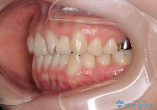 前歯のねじれ・ガタガタを10か月で改善!20代女性の矯正治療|クリアブラケットでむし歯になりにくい歯並びへ改善の治療前