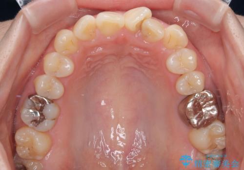 前歯のねじれ・ガタガタを10か月で改善!20代女性の矯正治療|クリアブラケットでむし歯になりにくい歯並びへ改善の治療前