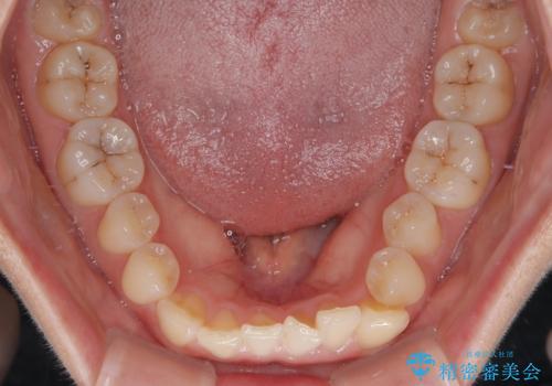 前歯のねじれ・ガタガタを10か月で改善!20代女性の矯正治療|クリアブラケットでむし歯になりにくい歯並びへ改善の治療前