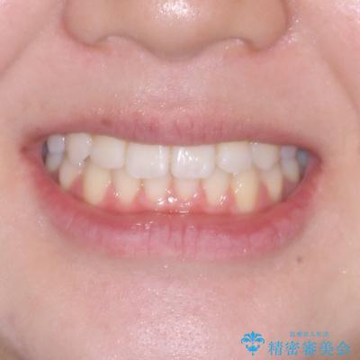 前歯のクロスバイト 裏側に隠れた歯をワイヤー装置で短期間治療の治療後(顔貌)