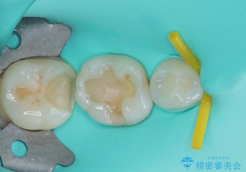 右下に虫歯ができた セラミックインレー修復の治療中