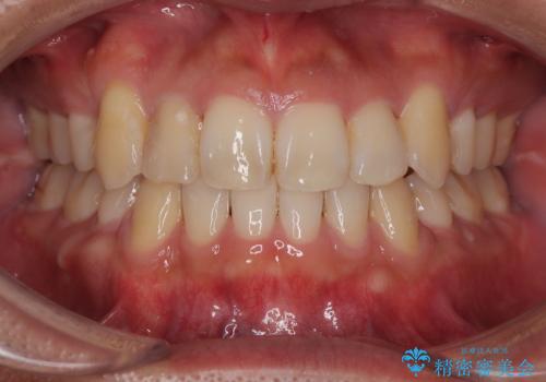 八重歯と前歯のガタガタを抜歯矯正で治療|クリアブラケット使用例の症例 治療後
