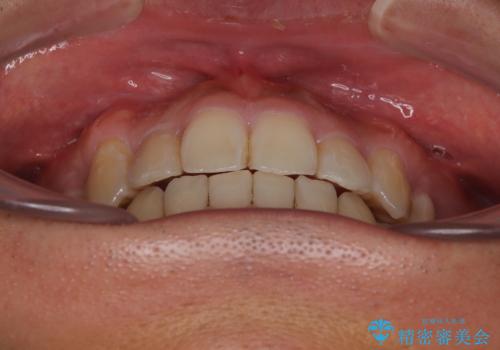 八重歯と前歯のガタガタを抜歯矯正で治療|クリアブラケット使用例の治療後