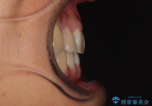 八重歯と前歯のガタガタを抜歯矯正で治療|クリアブラケット使用例の治療後