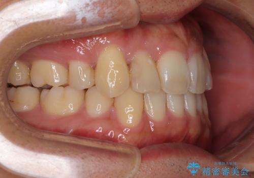 八重歯と前歯のガタガタを抜歯矯正で治療|クリアブラケット使用例の治療後