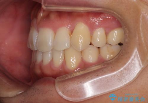 八重歯と前歯のガタガタを抜歯矯正で治療|クリアブラケット使用例の治療後