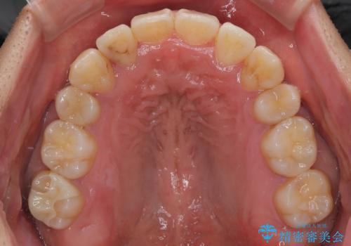 八重歯と前歯のガタガタを抜歯矯正で治療|クリアブラケット使用例の治療後