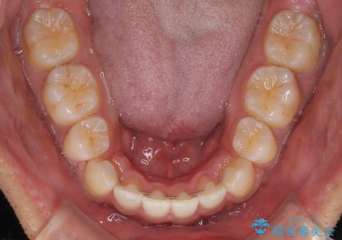 八重歯と前歯のガタガタを抜歯矯正で治療|クリアブラケット使用例の治療後