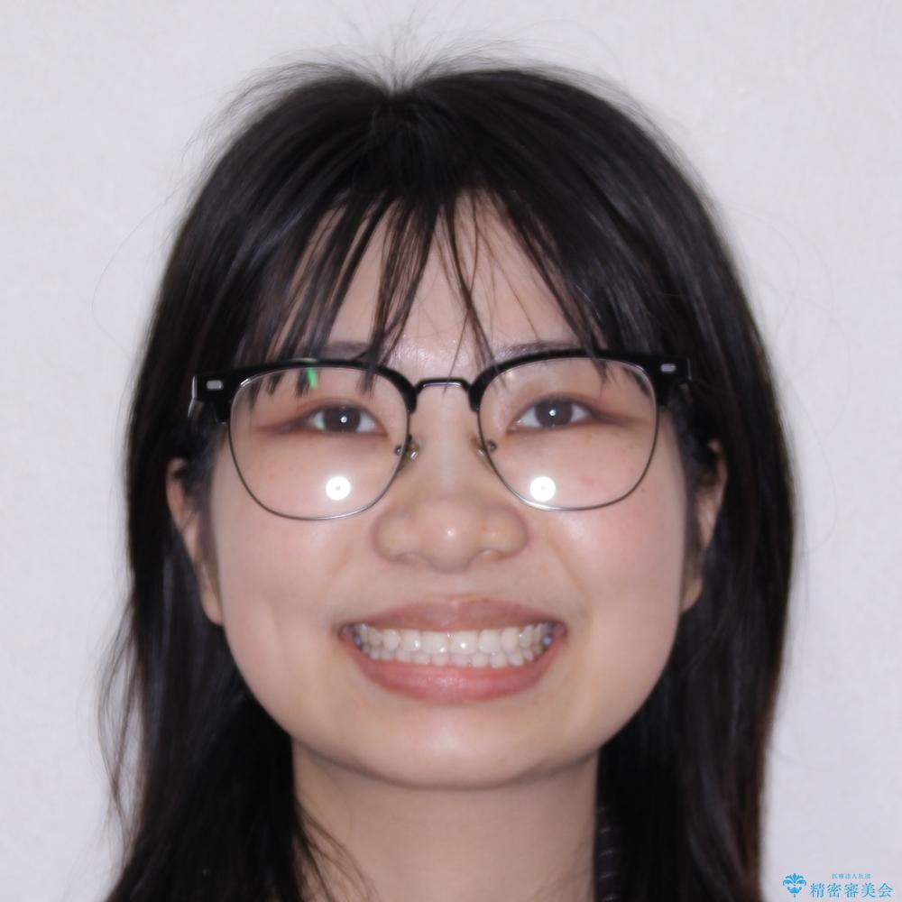 【モニター】マウスピース矯正が煩わしい ワイヤー装置での非抜歯矯正の治療後(顔貌)