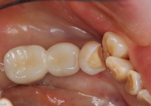 乱ぐい歯 虫歯治療 セラミックインレーの治療中