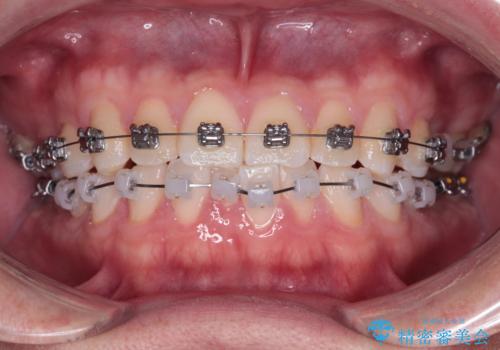 前歯のガタガタ・奥歯のかみ合わせ(シザーズバイト)を改善|1年半で完了したメタルブラケット矯正の治療中