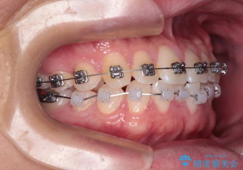 前歯のガタガタ・奥歯のかみ合わせ(シザーズバイト)を改善|1年半で完了したメタルブラケット矯正の治療中